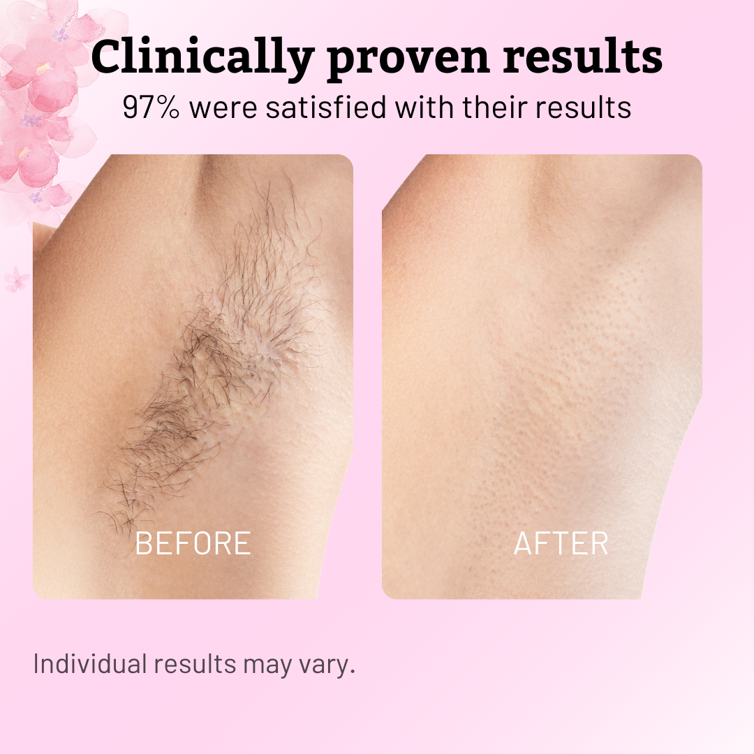 Cyperus Rotundus Oil for Natural Permanent Hair Reduction